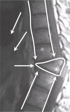 Thoracic spine trauma. Sagittal T1-weighted MRI im