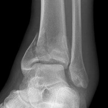 Anteroposterior radiograph of a pilon fracture in 