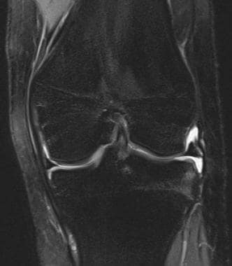 Normal anterior cruciate ligament (ACL) in coronal