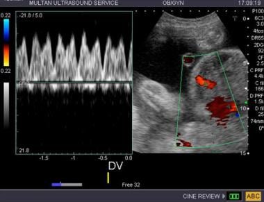 Twin-twin transfusion syndrome. The ductus venosus