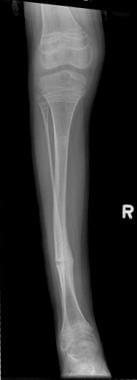 Frontal radiograph of the leg in a patient with ty