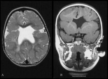 Schizencephaly. Axial T2-weighted (left) and coron