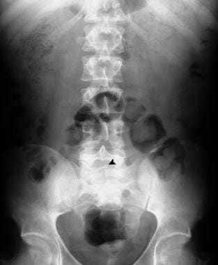 Plain abdominal radiograph in the same patient as 