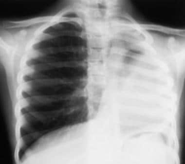 Radiograph showing left pulmonary hypoplasia. 