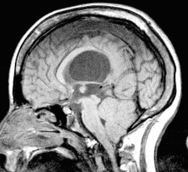 Sagittal T1-weighted MRI scan of a 15-year-old gir