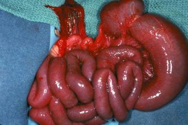Gross example of colonic atresia. 