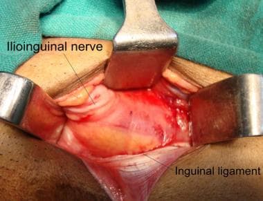 Open inguinal hernia repair. Reflected part of ing