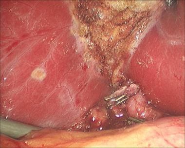 Laparoscopic cholecystectomy. Irrigation and sucti