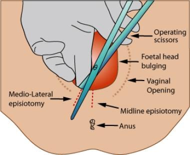 Episiotomy suture store