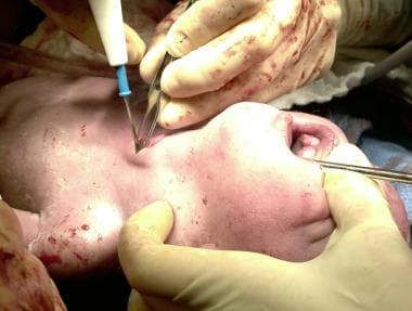 Tracheostomy performed during EXIT procedure for d