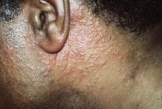 glp 1 fibromyalgia GLP-1s May Ease Symptom Burden in Patients With Fibromyalgia