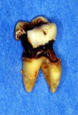 Severe root surface and occlusal caries that neces