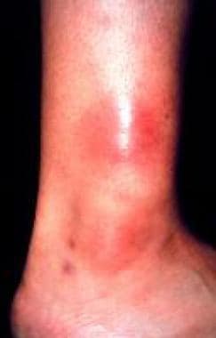 Erythema nodosum–like lesions on skin. 
