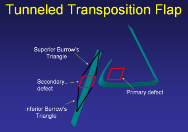 Tunneled transposition flap. 