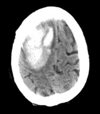 Intracranial hemorrhage. CT scan of right frontal 