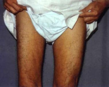 leg muscle atrophy