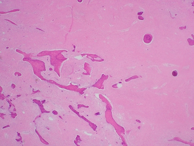 Fibrous Dysplasia Pathology. This is a low-power h