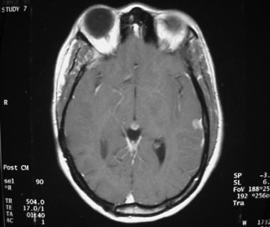 Multiple meningiomas (on the left) on the surface 