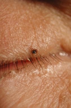 Focal melanoma of the upper lid in a patient with 