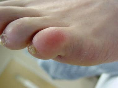 Fifth-toe deformities. Example of hammertoe with d