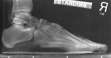 Pes cavus with plantarflexion of first ray. 