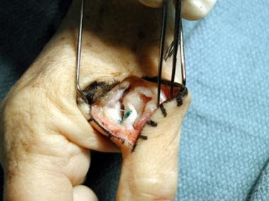 Completed repair using suture anchors for fixation