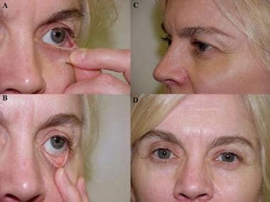 A: The lower eyelid is evaluated for the presence 