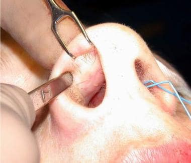Basic closed technique for rhinoplasty. The caudal