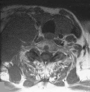 Coronal magnetic resonance imaging (MRI) section i