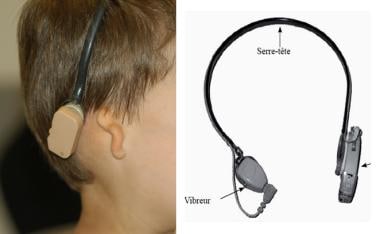 Bone-anchored hearing systems. Conventional bone-c