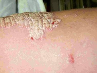 Plaque psoriasis is raised, roughened, and covered