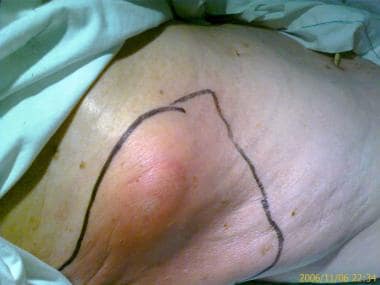 A 90-year-old man referred with abdominal wall abs