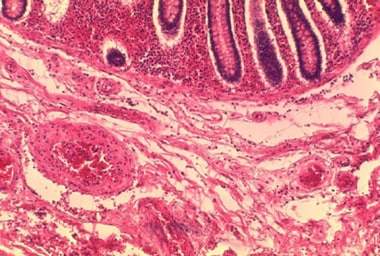Histopathology of the large intestine showing subm