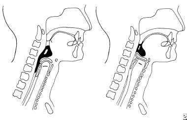 Pharyngeal phase of normal swallowing.