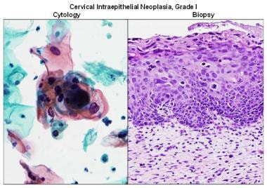 Cervical intraepithelial neoplasia grade I. 