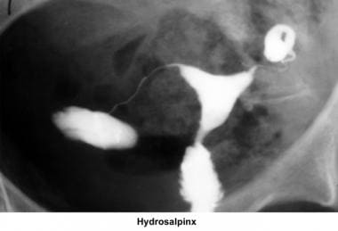 Hydrosalpinx. Image courtesy of Jairo E. Garcia, M