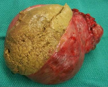 Mature cystic teratoma of the ovary with hair, seb