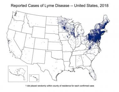 Lyme disease in the United States is concentrated