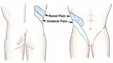 Flank pain radiating to the suprapubic region