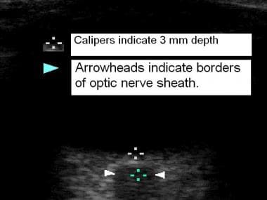 Ultrasonography. Optic nerve sheath diameter measu