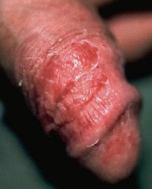 Candidiasis. Dry, red, superficially scaly, prurit
