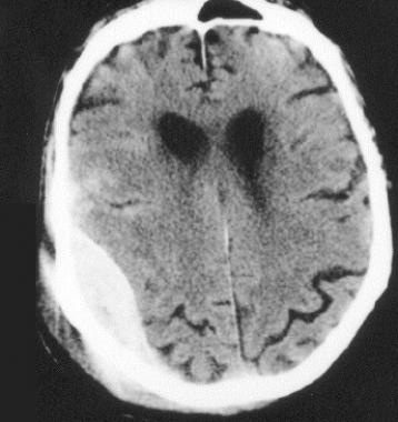 Brain CT scan of 90-year-old man who slipped on a 