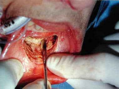 Access for an intraoral placement of an alloplasti