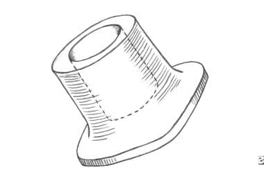 Goldenberg hydroxylapatite footplate shoe. 
