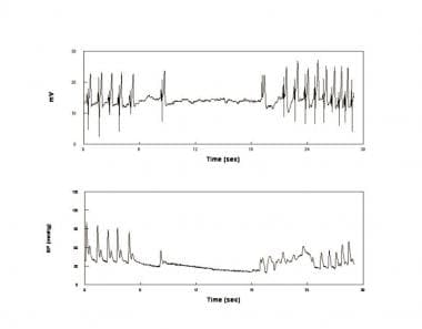 An asystolic faint. Electrocardiogram (upper panel
