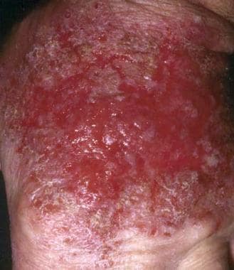 Areas of acute contact dermatitis respond well to 