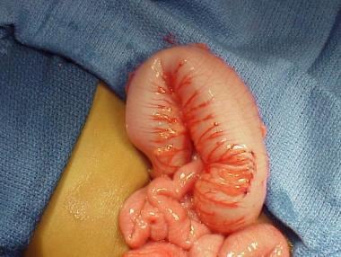 Pediatric Hirschsprung disease. Intraoperative fin