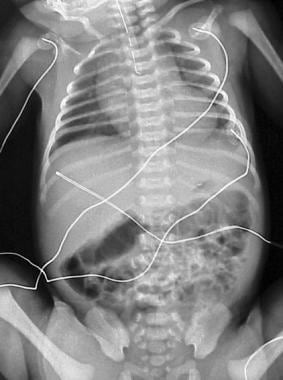 Plain radiograph in newborn suspected of having es