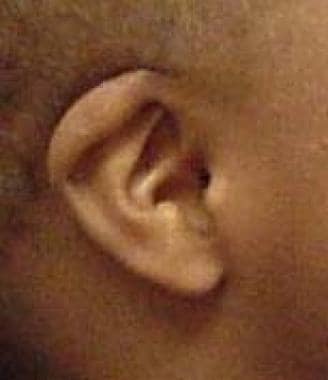 Ear of infant with Down syndrome. Note characteris