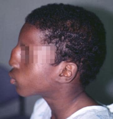 Lateral view of a preteenaged child showing infect